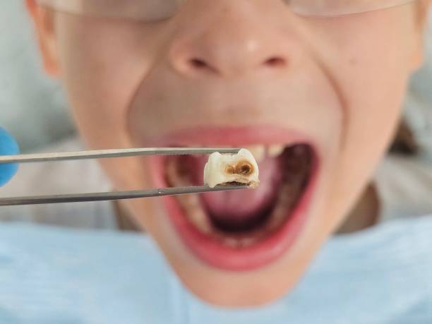 Best Tooth Infection Emergency Dentist  in Fort Carson, CO