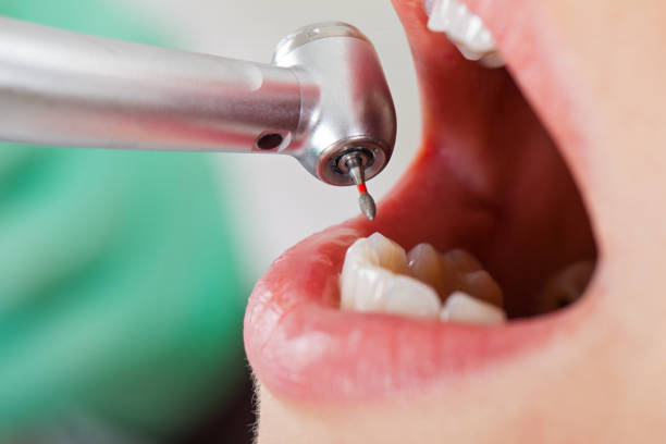 Best Knocked-Out Tooth Emergency  in Fort Carson, CO